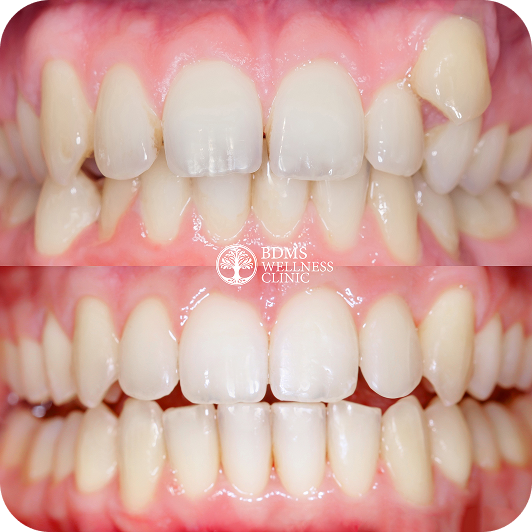 Why Choose Invisalign